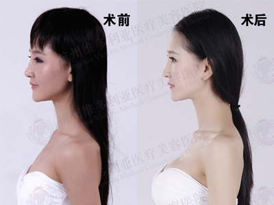 隆胸前后对比图